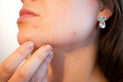 Femme souffrant d'acné au visage